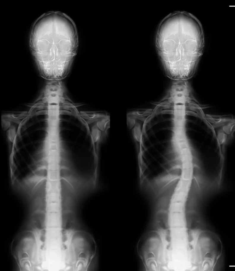 scoliosis Ames IA